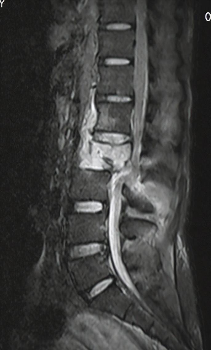 从瘫痪到重头站起来,瘫痪后重头站起来的有吗