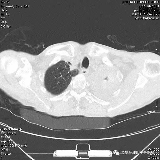 肺手术后乳糜胸是医疗事故吗,肺部切除后乳糜胸治好了