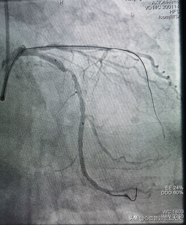 CTO遇到钙化病变怎样才能把血管打通？