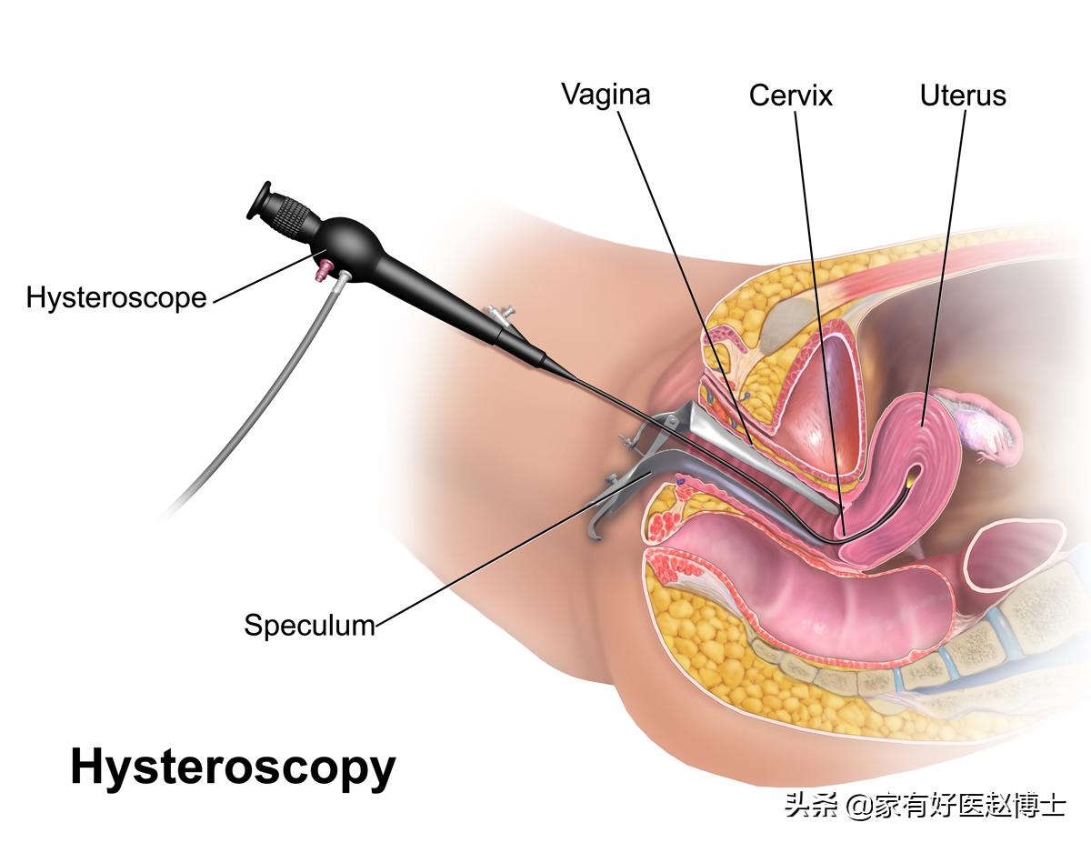 最常见5类息肉每个人都可能有，哪些无癌变风险，哪些需要切除？