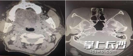 癌症晚期耳朵流脓,耳朵里长肿瘤而且流血流脓
