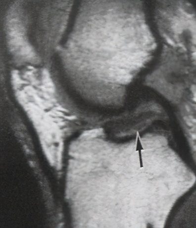 前交叉韧带损伤核磁共振,前后交叉韧带损伤的治疗