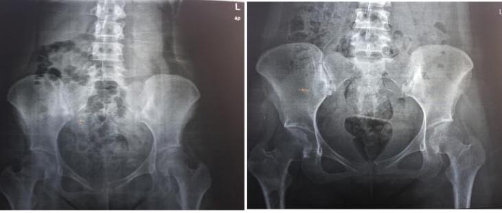 产后腰痛是月子没有坐好吗,怎样坐好月子不腰痛