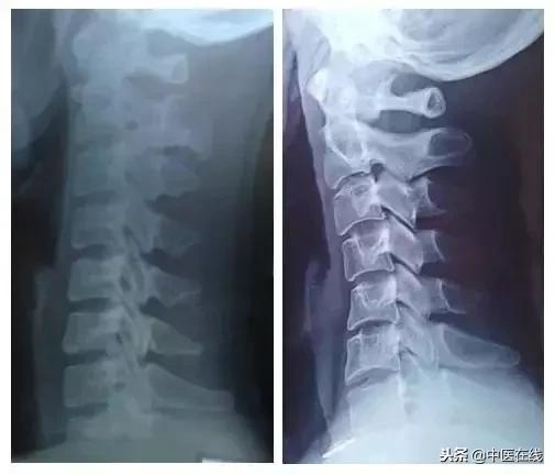北京中医医院马彦旭主任：你的颈椎变直了么？别怕，中医有办法！