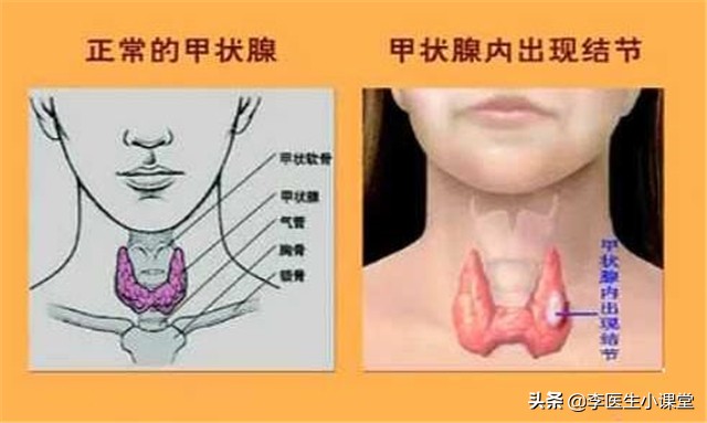 甲状腺结节吃什么药才能散结,甲状腺囊实性结节吃啥药能散结