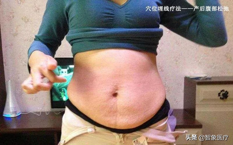 肚子大穴位埋线有效吗,穴位埋线腹部塑形