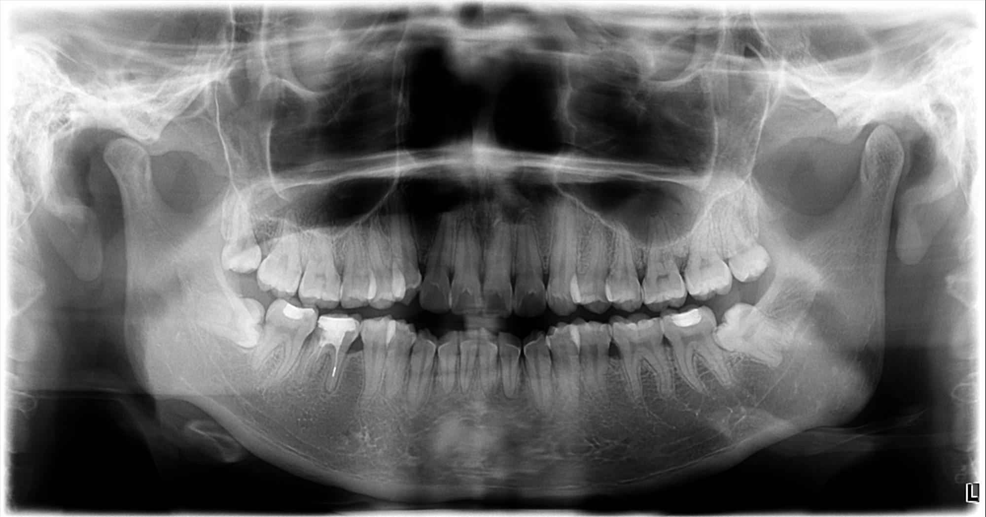戴全牙套,初学者戴牙套的感受