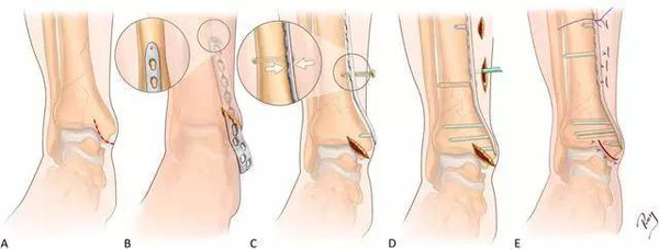 关节磨损护骨方法,预防骨关节磨损