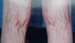 小伙腿上银屑病,男大学生截肢事件