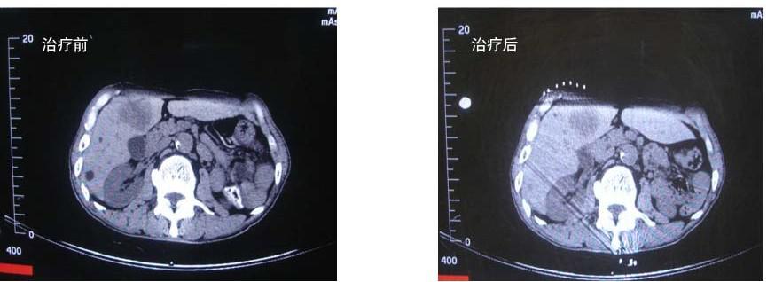 食管癌晚期转移肝脏靶向治疗,食道癌术后肝转移治疗案例
