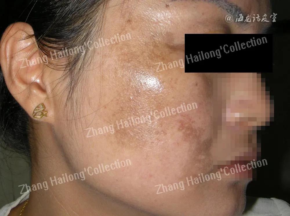 褐斑怎么治用什么药,脸黄长褐斑