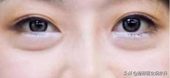 做眼袋用什么护肤品,眼袋大怎么办用什么眼霜好