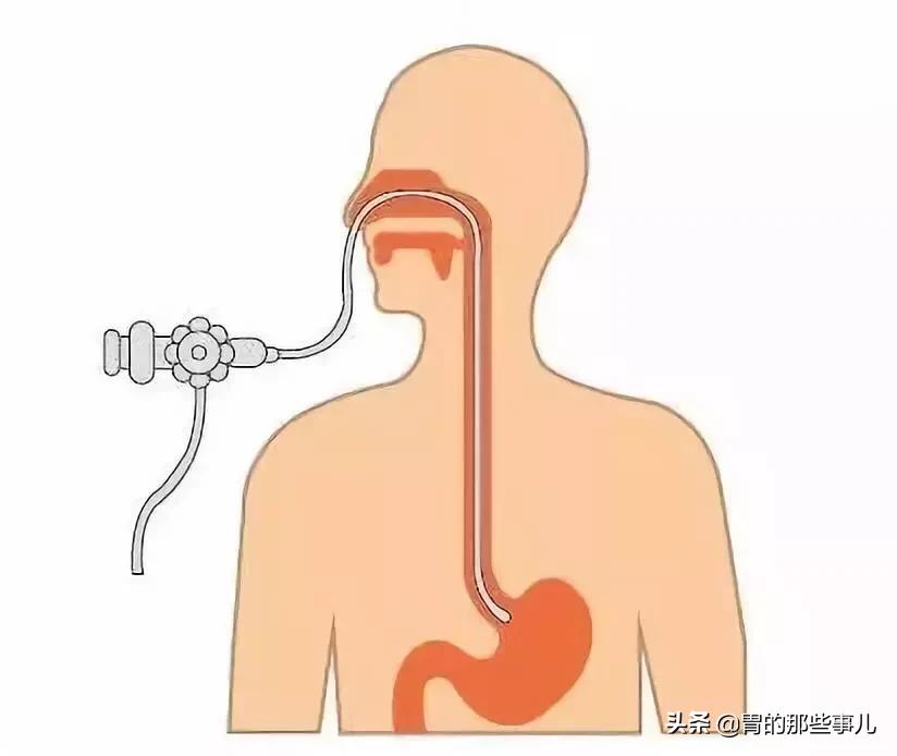 肠胃镜误区,揭秘胃镜检查的几大误区