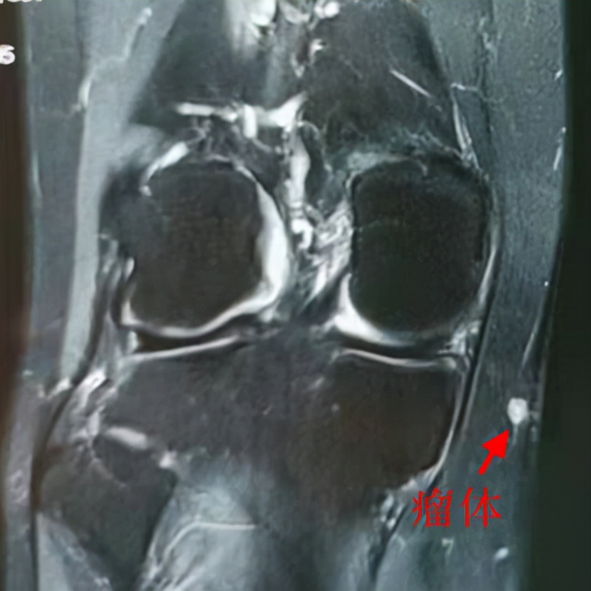 膝盖疼了2年查不出原因,膝盖不明原因疼痛是什么原因