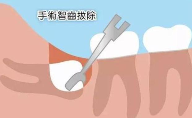 拔牙后出血的原因及处理,拔牙后出血不止怎么处理