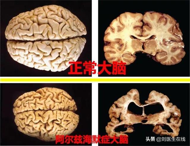 老年人体检出来脑萎缩,脑白质稀疏脑萎缩是老年痴呆吗