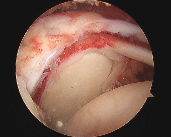 肩袖损伤要怎么处理,肩袖损伤专用膏药