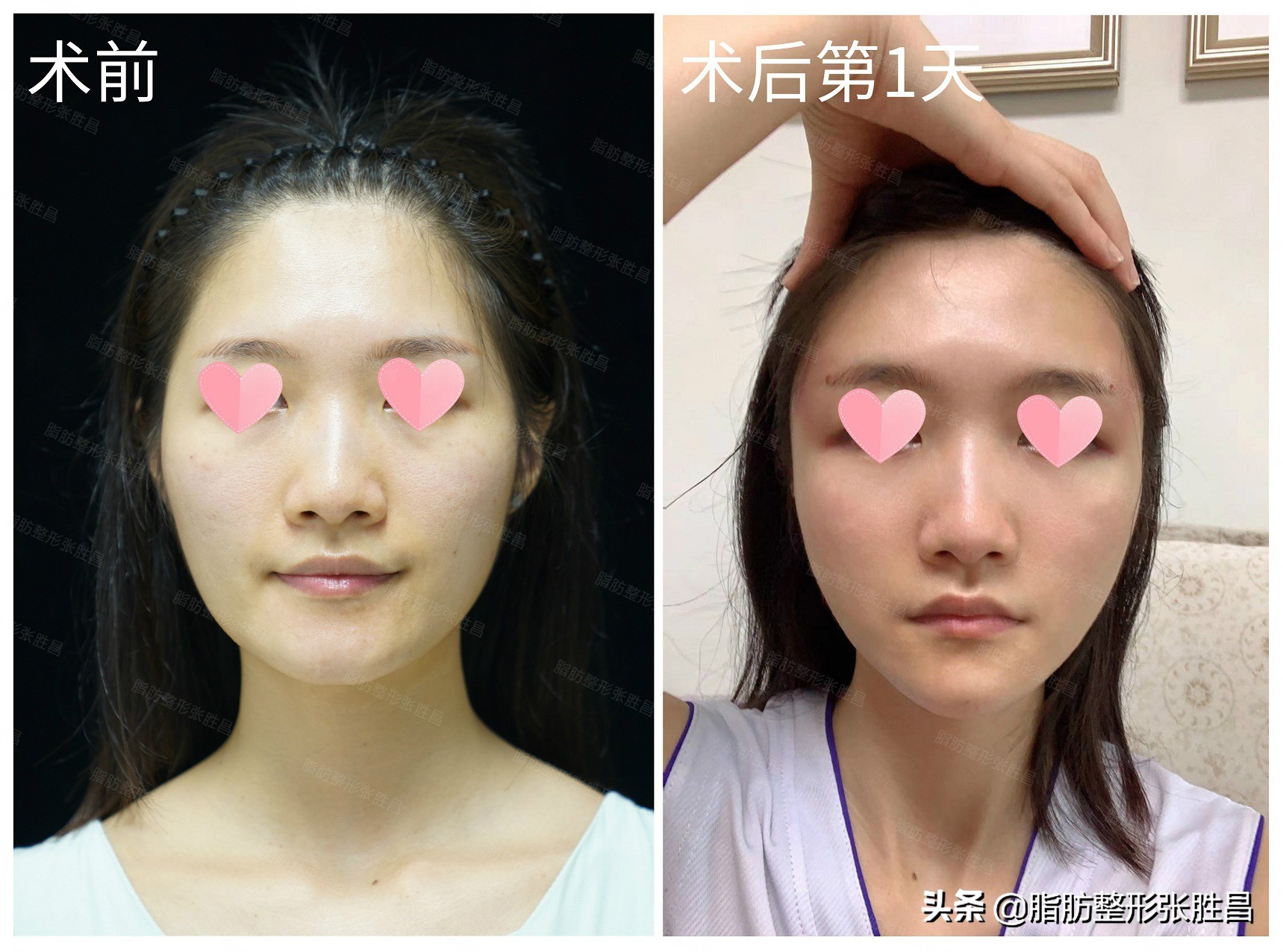 面部特别凹陷的人命运,面部凹陷超显老