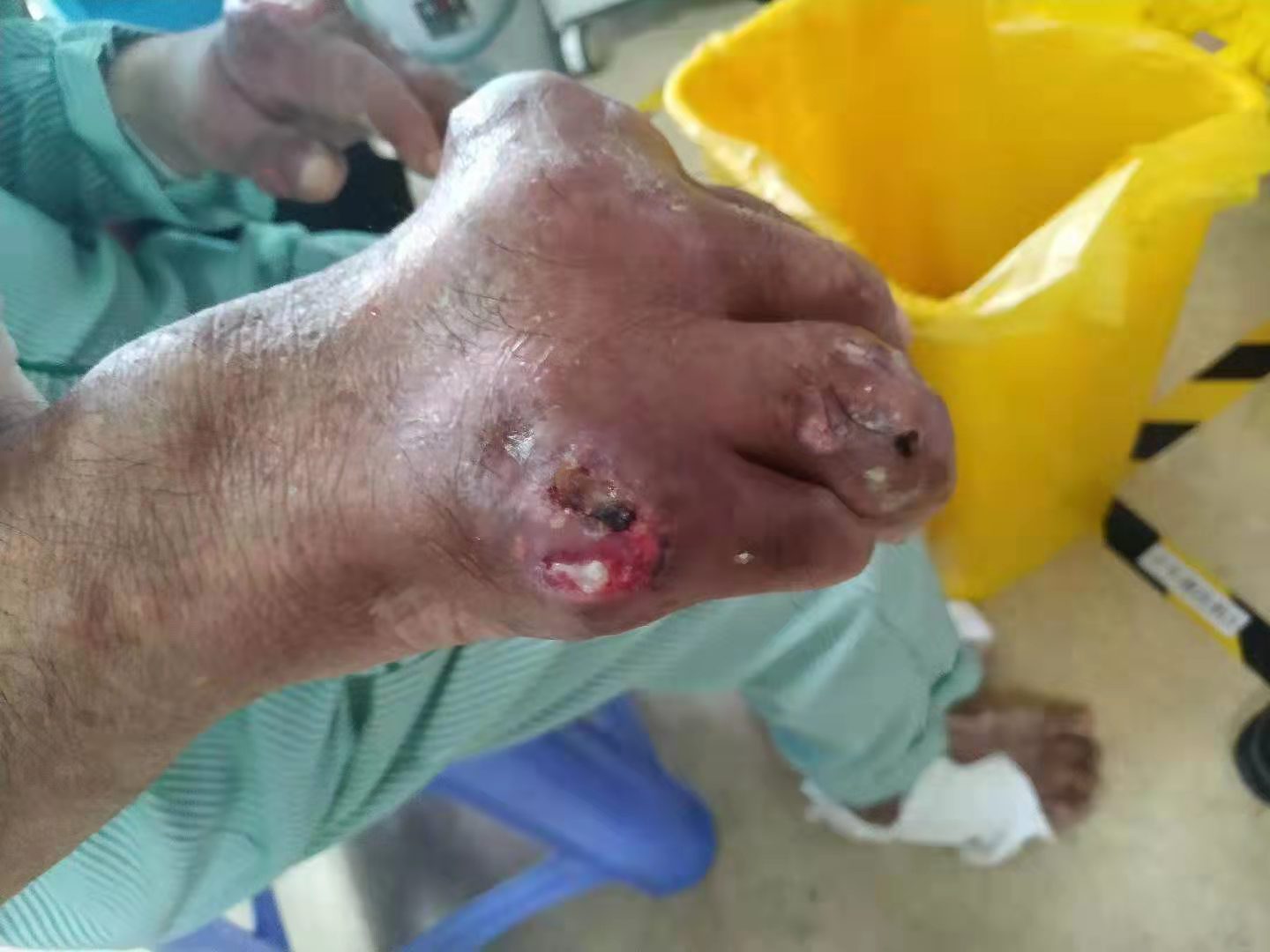 尿酸从646降到443，多发痛风石变小、变软，只因这两个名方