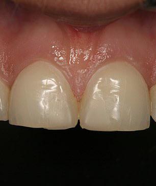 长期过度饮酒对牙齿的危害,长期吸烟喝酒的牙齿长什么样子