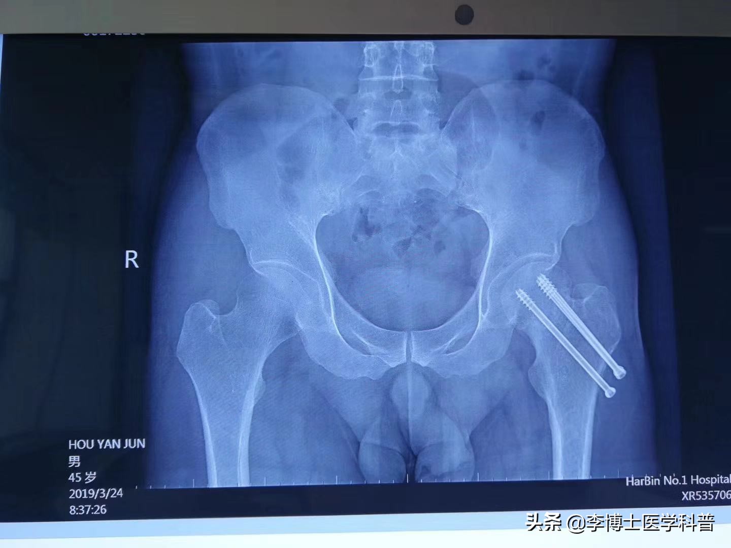 骨头摔折了3年没长上你说怎么办？其它方式不行，我们还有冲击波