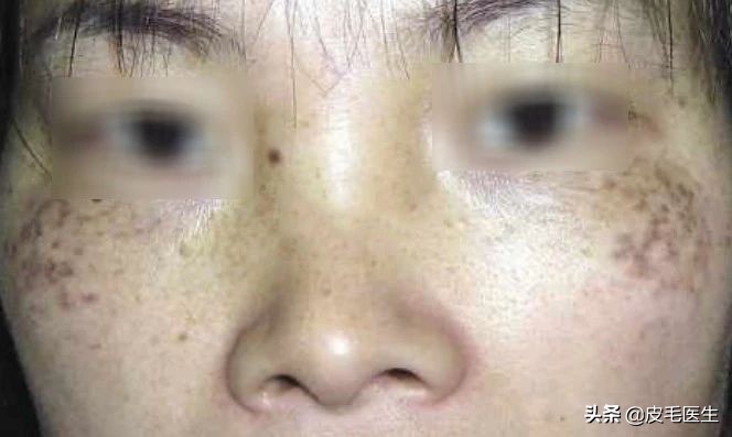 脸上斑斑点点最佳治疗方法,脸上斑斑点点小妙招