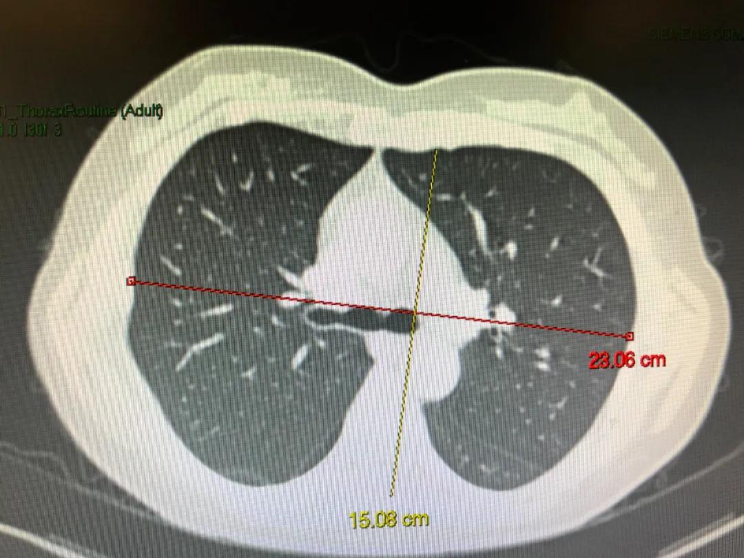 慢阻肺是桶状胸,慢阻肺会出现桶状肺吗