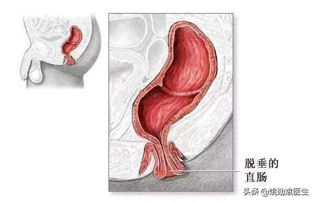 皮肤病是怎么引起的肛门瘙痒症,有哪些特效药可治肛门瘙痒症