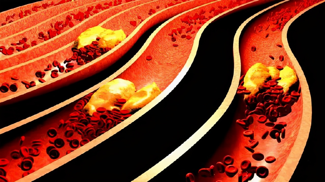 喘不上气是因为揉腿？为啥要警惕两腿围相差1cm？