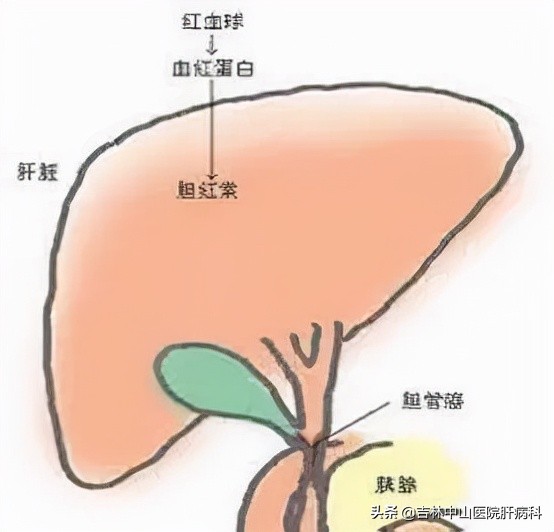 胆囊炎胆红素升高,胆红素升高怎么办呢