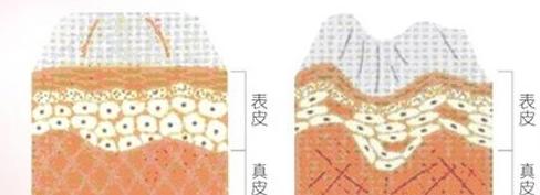 面部衰老除了线雕还可以做什么,线雕提升抗衰老