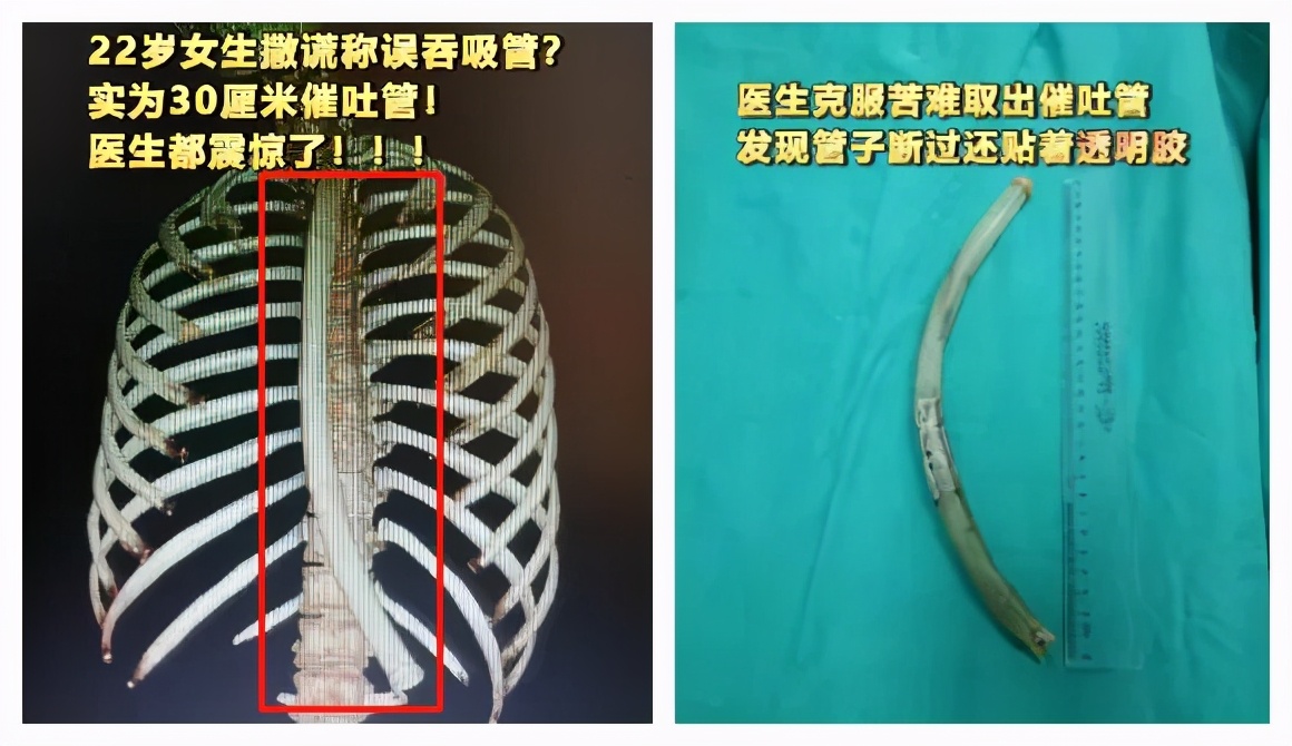 仙女管催吐的危害,女子减肥把塑料管插胃里