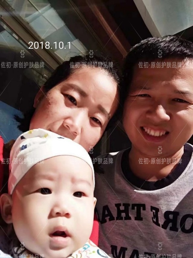 生完孩子烂脸,生完孩子脸上垮了怎样处理