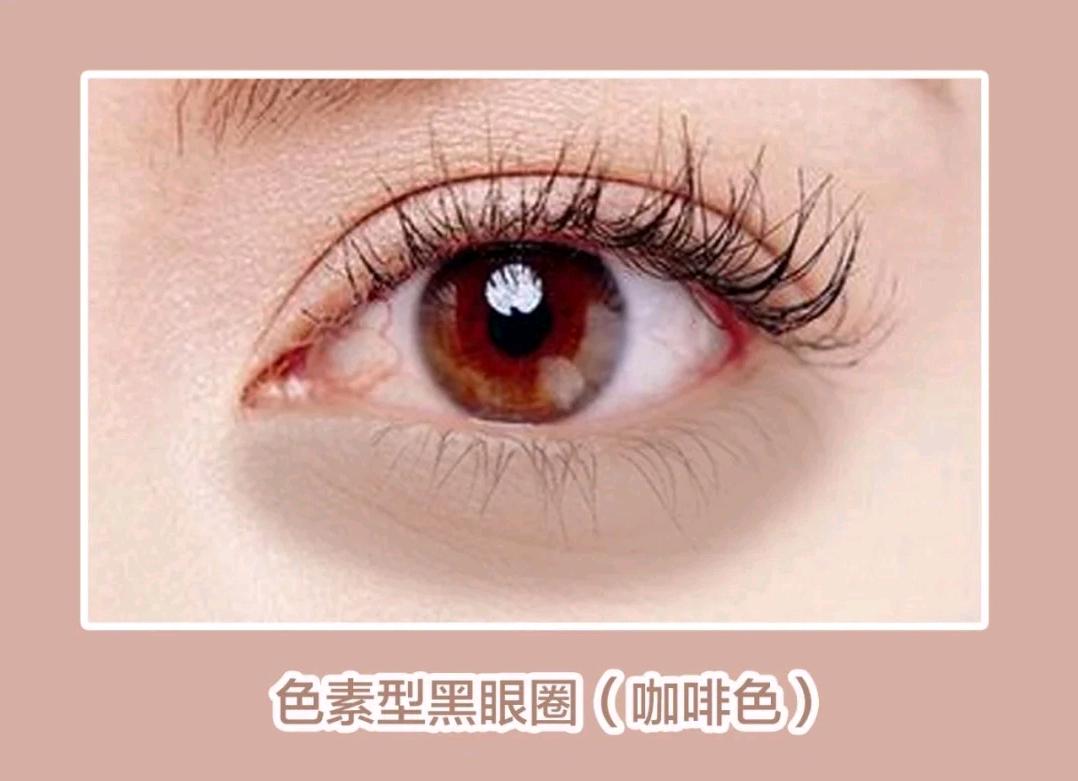 你的黑眼圈从哪来,你的黑眼圈是什么颜色