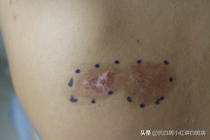 白癜风患者治好的全过程,白癜风治愈患者分享痊愈经验