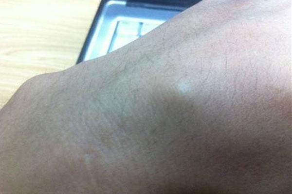 脂肪瘤图片,脂肪瘤变成恶性肿瘤的概率