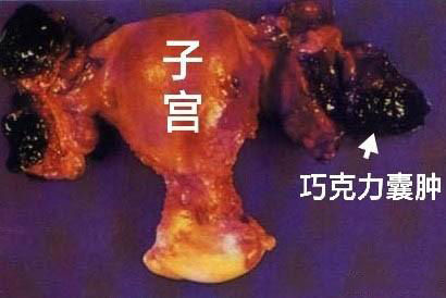 巧克力囊肿是什么意思,巧克力囊肿相关知识