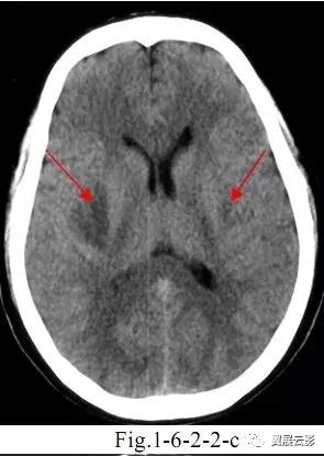 脑脓肿增强扫描是环形强化吗,脑部脓肿