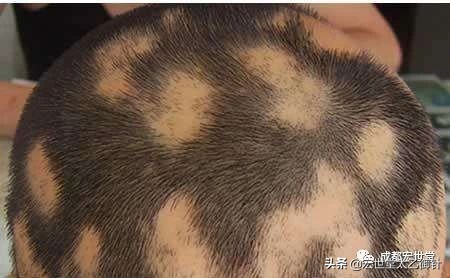 斑秃快秃了怎么办,斑秃秃顶头发能恢复吗