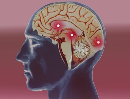 脑梗是“拖”出来的？脑梗来临前有哪些迹象？早知早受益