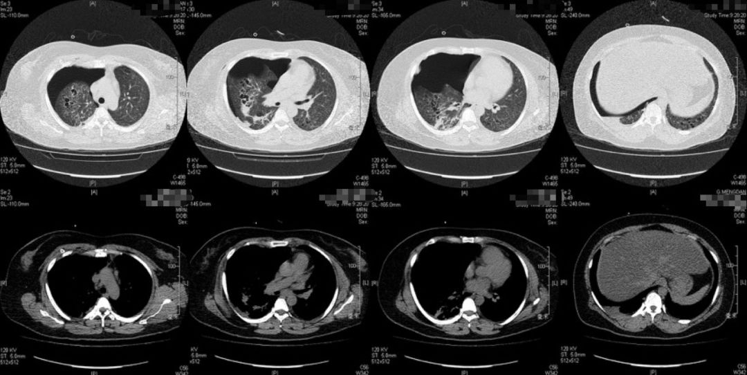 女性气胸的十大症状,女性气胸的十个表现