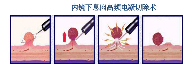 胃肠息肉会癌变么,长蒂息肉和无蒂息肉哪种容易癌变