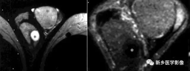 睾丸内部病变,睾丸病变mri
