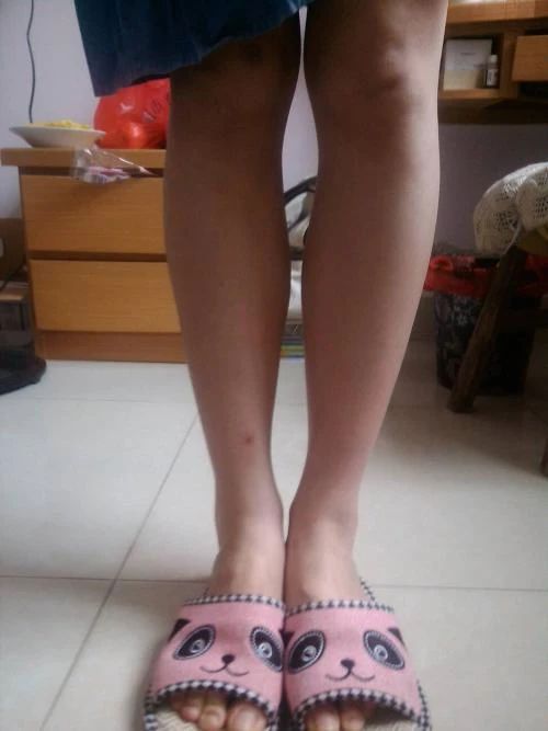 怎么判断小腿肌肉外翻和骨骼弯曲,小腿肌肉外翻和膝盖内扣一样吗