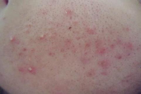 个别痘里面有白脓能挤吗,脓包型痘痘如何排出脓液