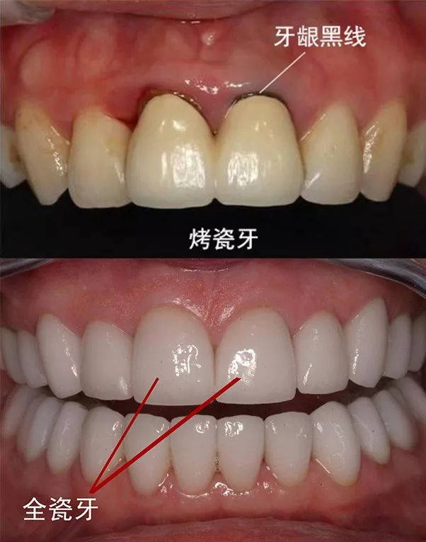 乳牙磕瓜子恒牙为什么变瓜子牙了,爱嗑瓜子