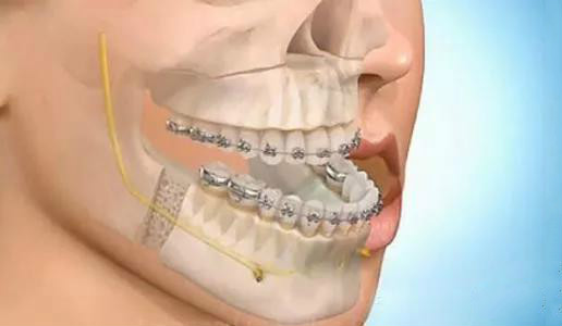 就两颗下排门牙不齐建议矫正吗,下牙不齐除了牙套还有什么方法