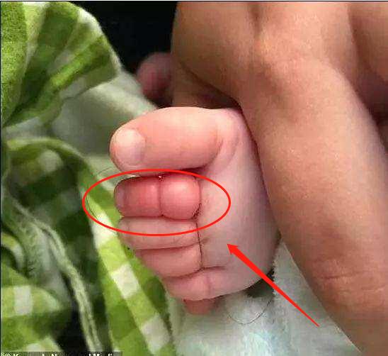 两岁宝宝腿上被虫子咬了肿很大,小孩脚后跟被蜱虫咬