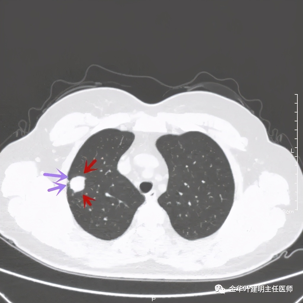 右上肺结节灶一般是什么癌,右上肺恶性肿瘤是肺癌吗