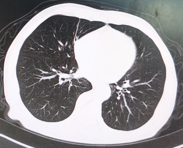 直肠癌转移肺部ct报告单怎样提示,直肠癌转移到肝肺部还能活多久